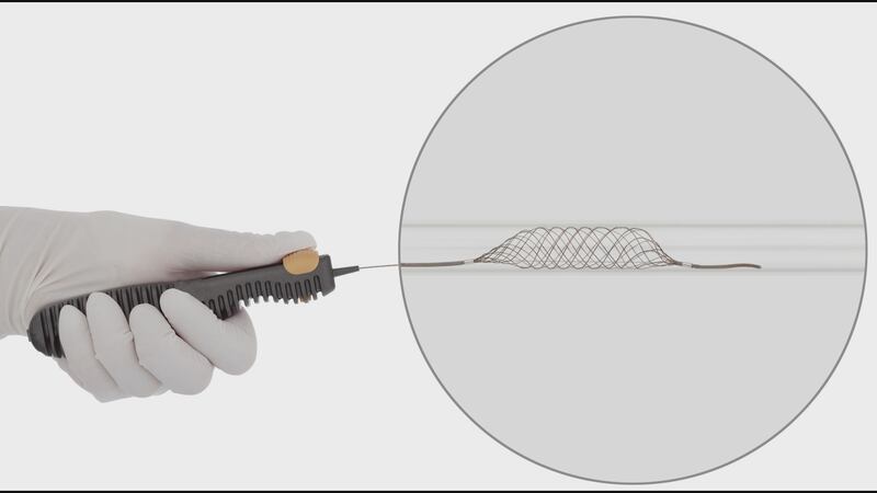 The Comaneci device, a new tool to treat brain aneurysms, minimizes the risk of stroke during...
